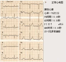 心电图检查详解