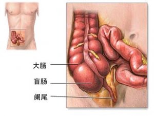 阑尾切除手术